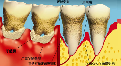 為什么說牙周病是可以預(yù)防的疾病