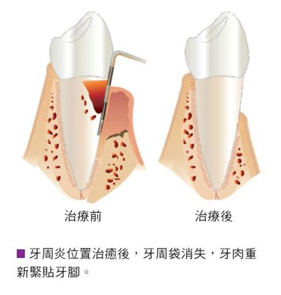 舒雅無痛牙周治療